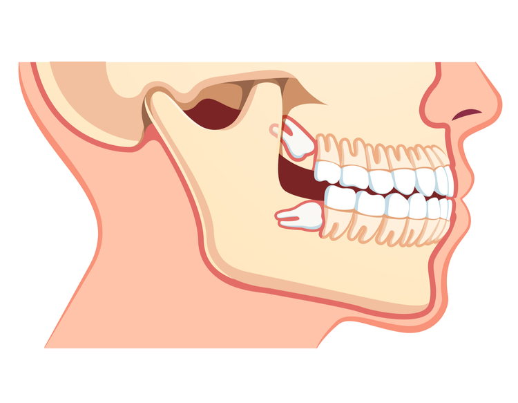 how-to-relieve-pain-from-a-wisdom-tooth-northernpossession24